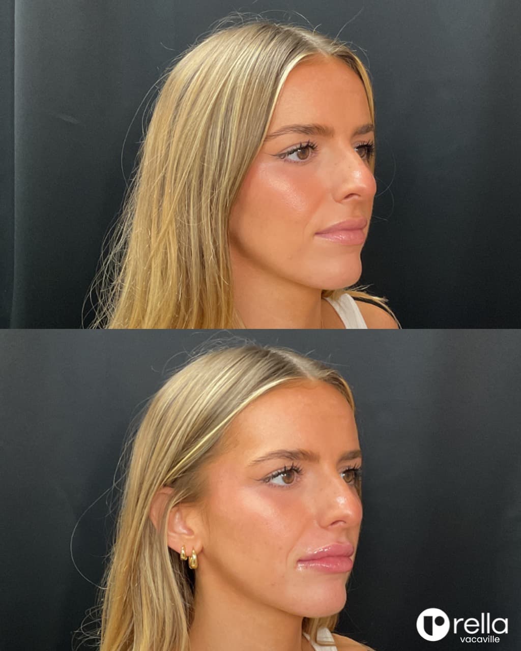 Before-and-after lip filler result shared with Rella Aesthetics