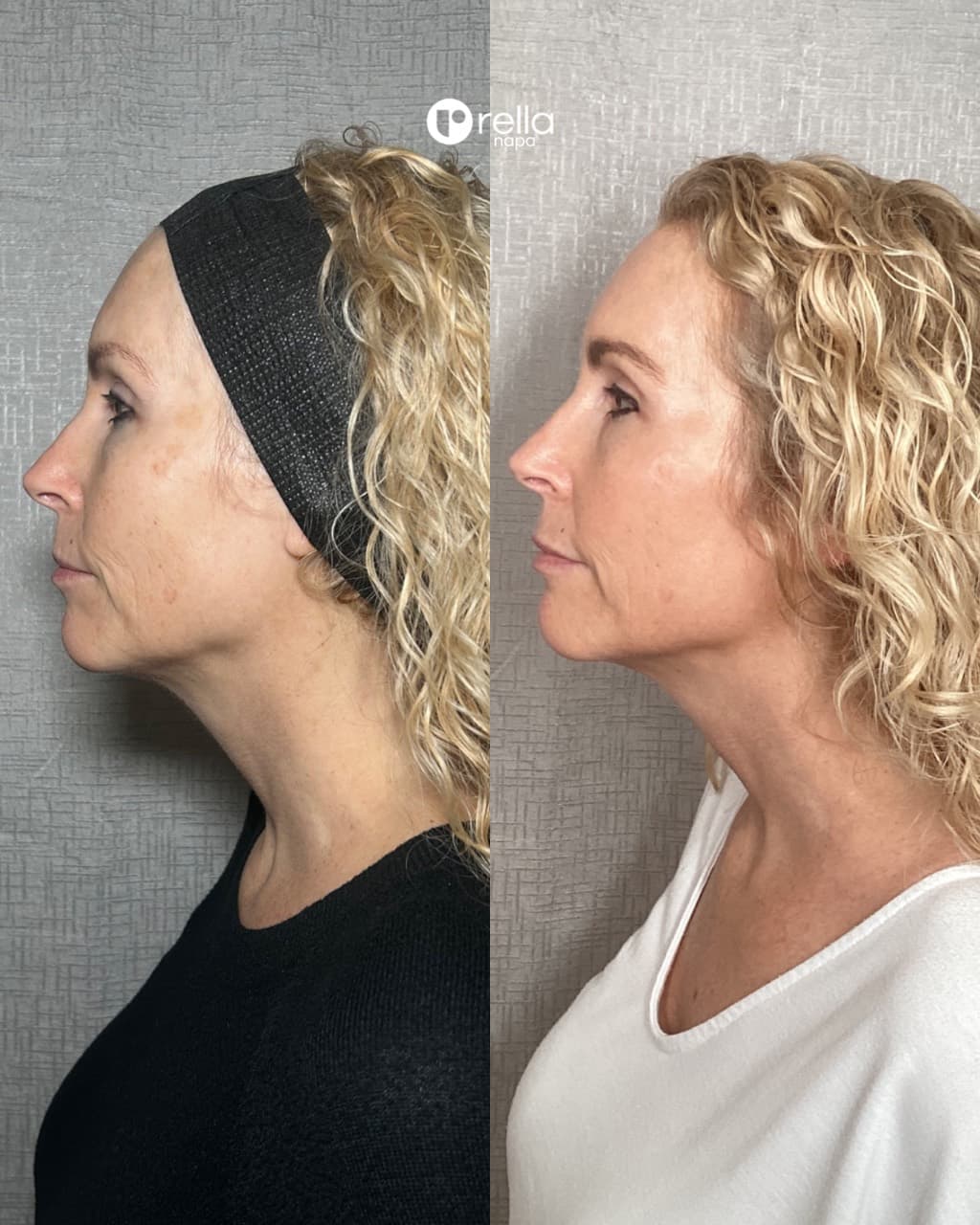 Before-and-after CoolPeel result shared with Rella Aesthetics