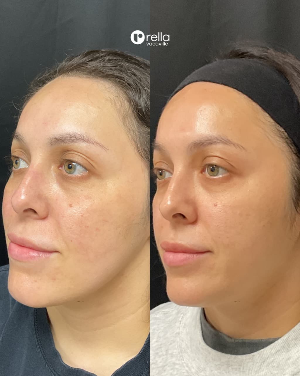 Before-and-after microneedling and CoolPeel result shared with Rella Aesthetics