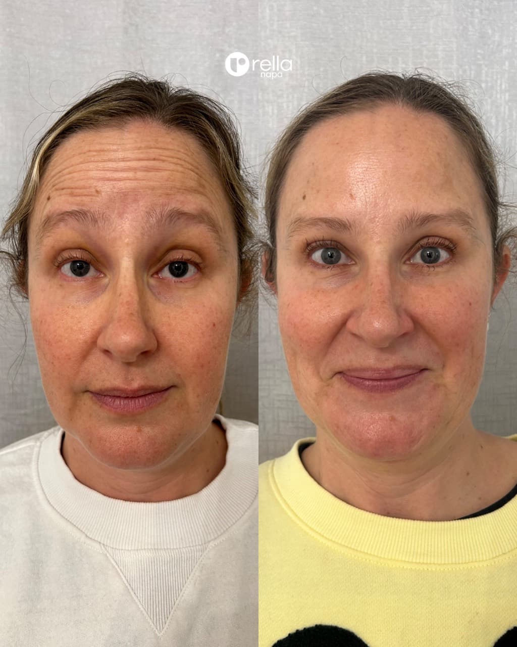 Before-and-after Botox result shared with Rella Aesthetics