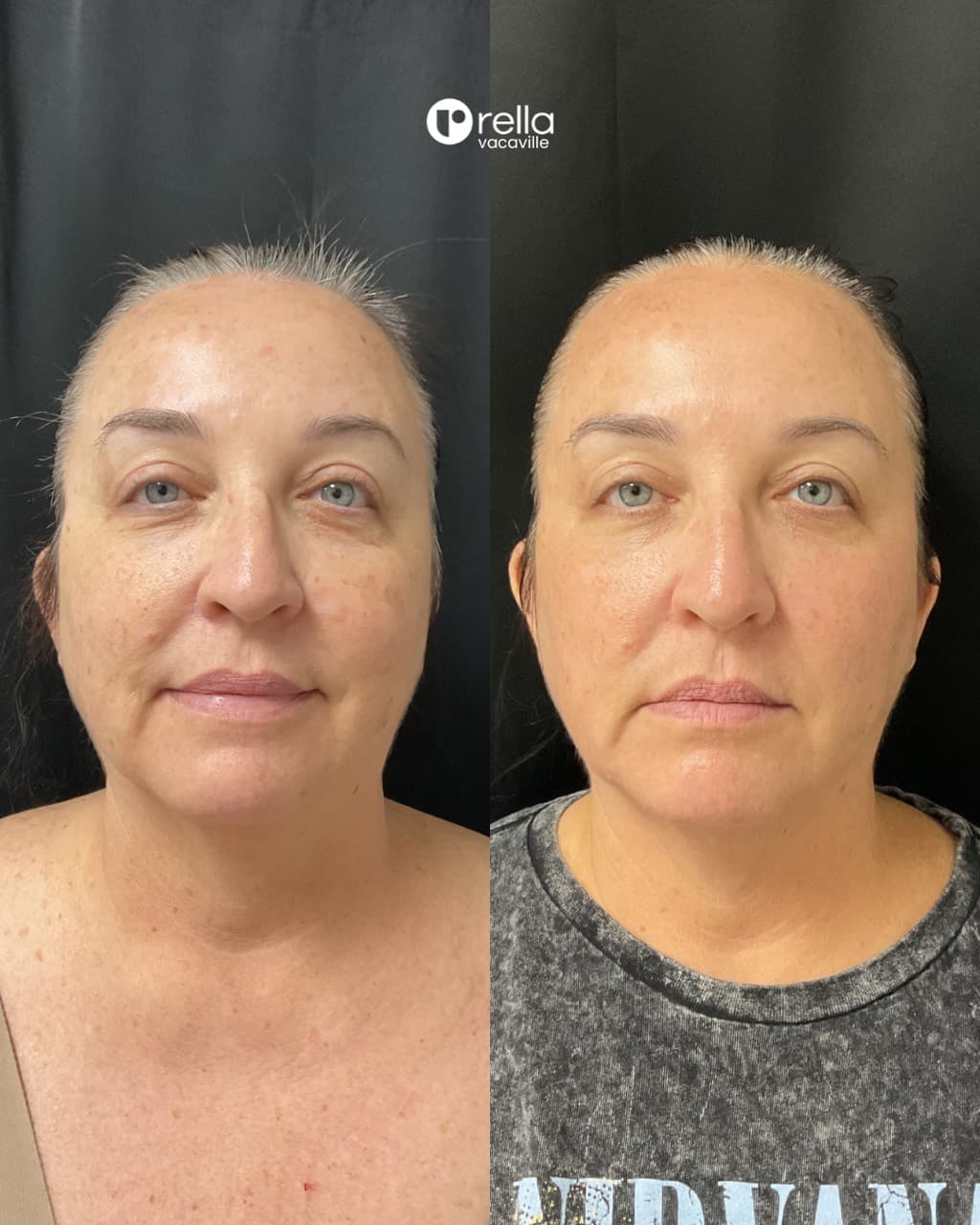 Before-and-after result from three CoolPeel sessions four weeks apart shared with Rella Aesthetics