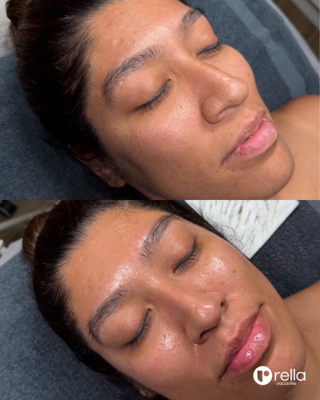 Before-and-after Deluxe HydraFacial result shared with Rella Aesthetics