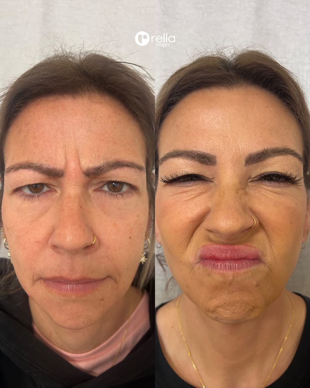 Before-and-after Botox result shared with Rella Aesthetics