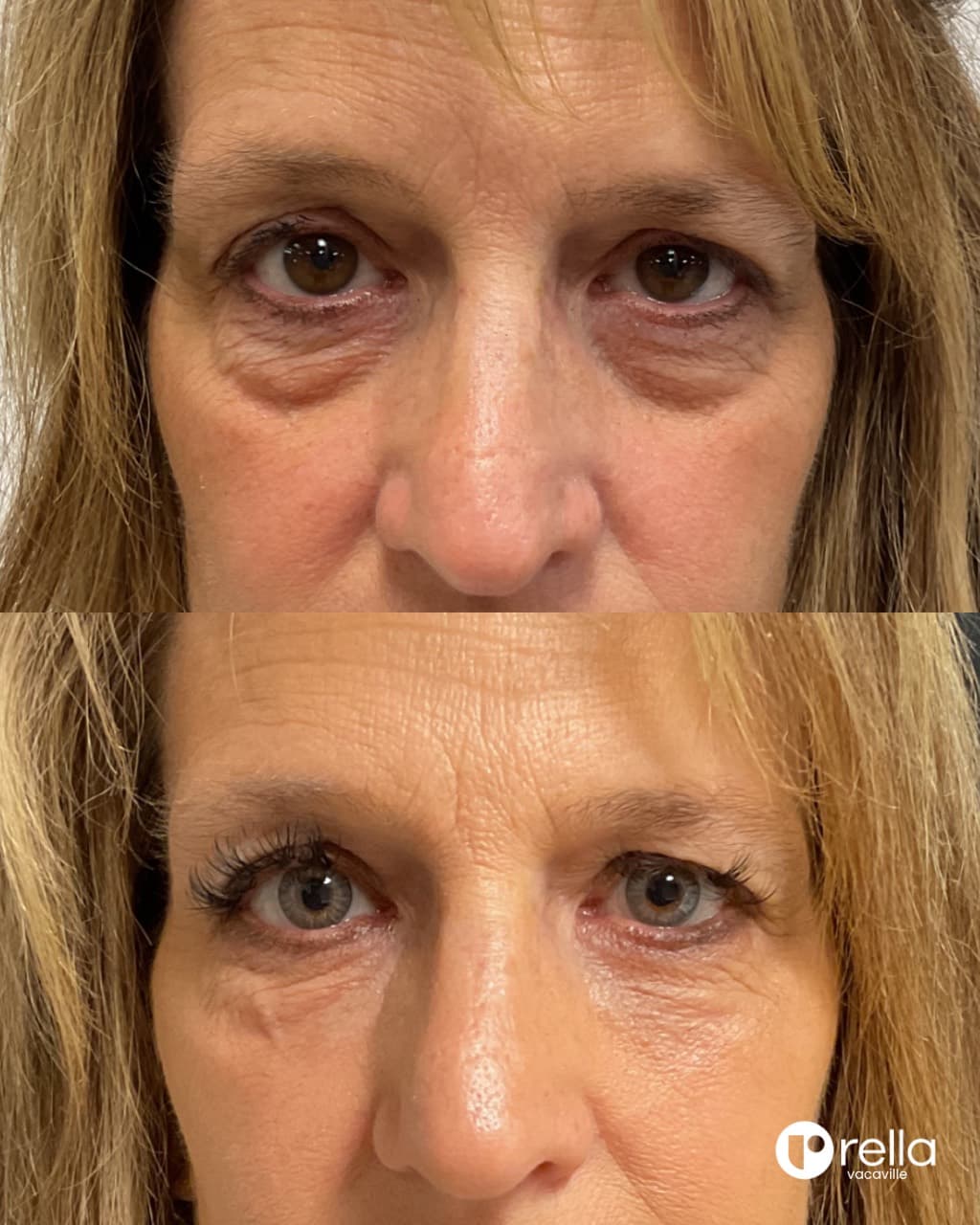 Before-and-after under-eye filler result shared with Rella Aesthetics