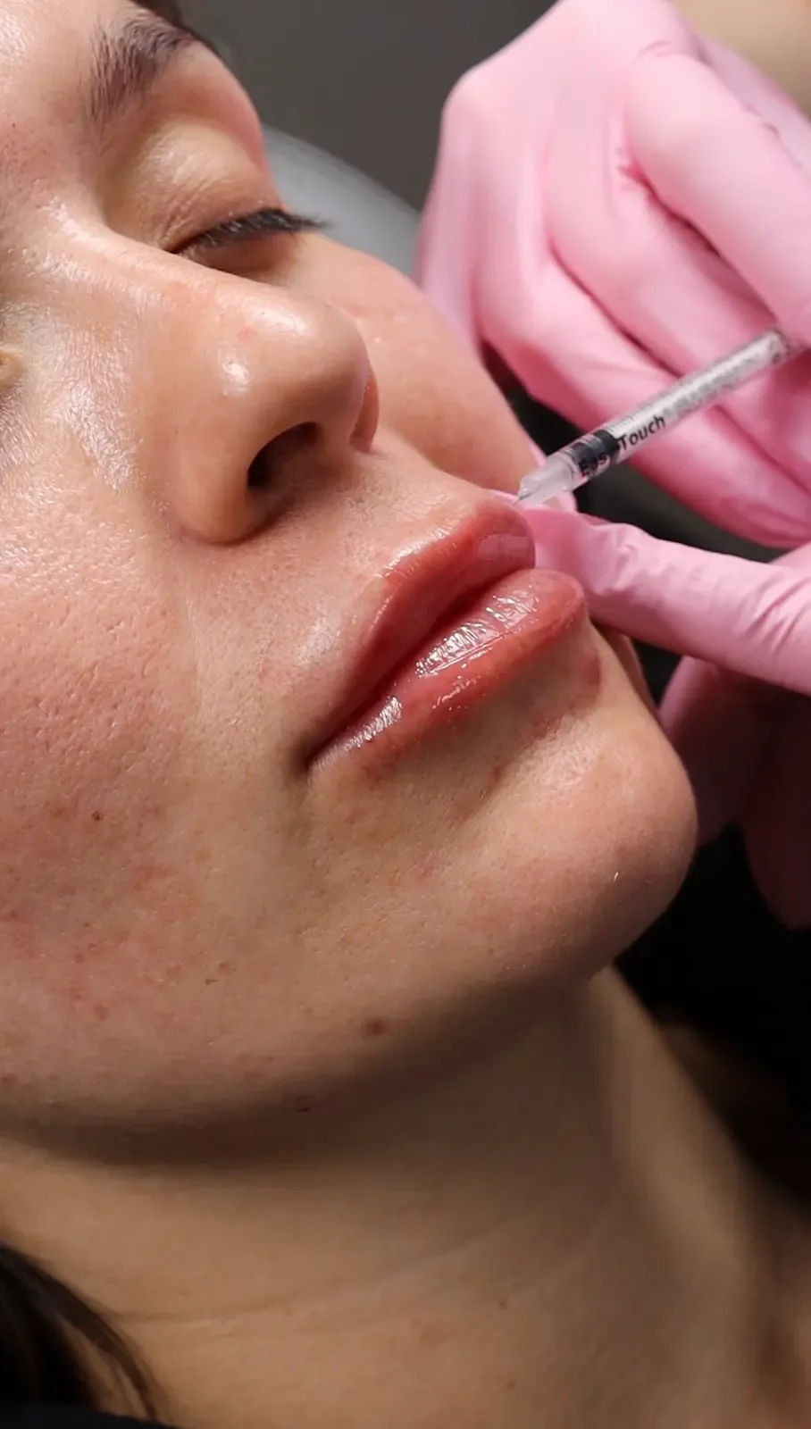 A Rella provider performing a careful injectable treatment