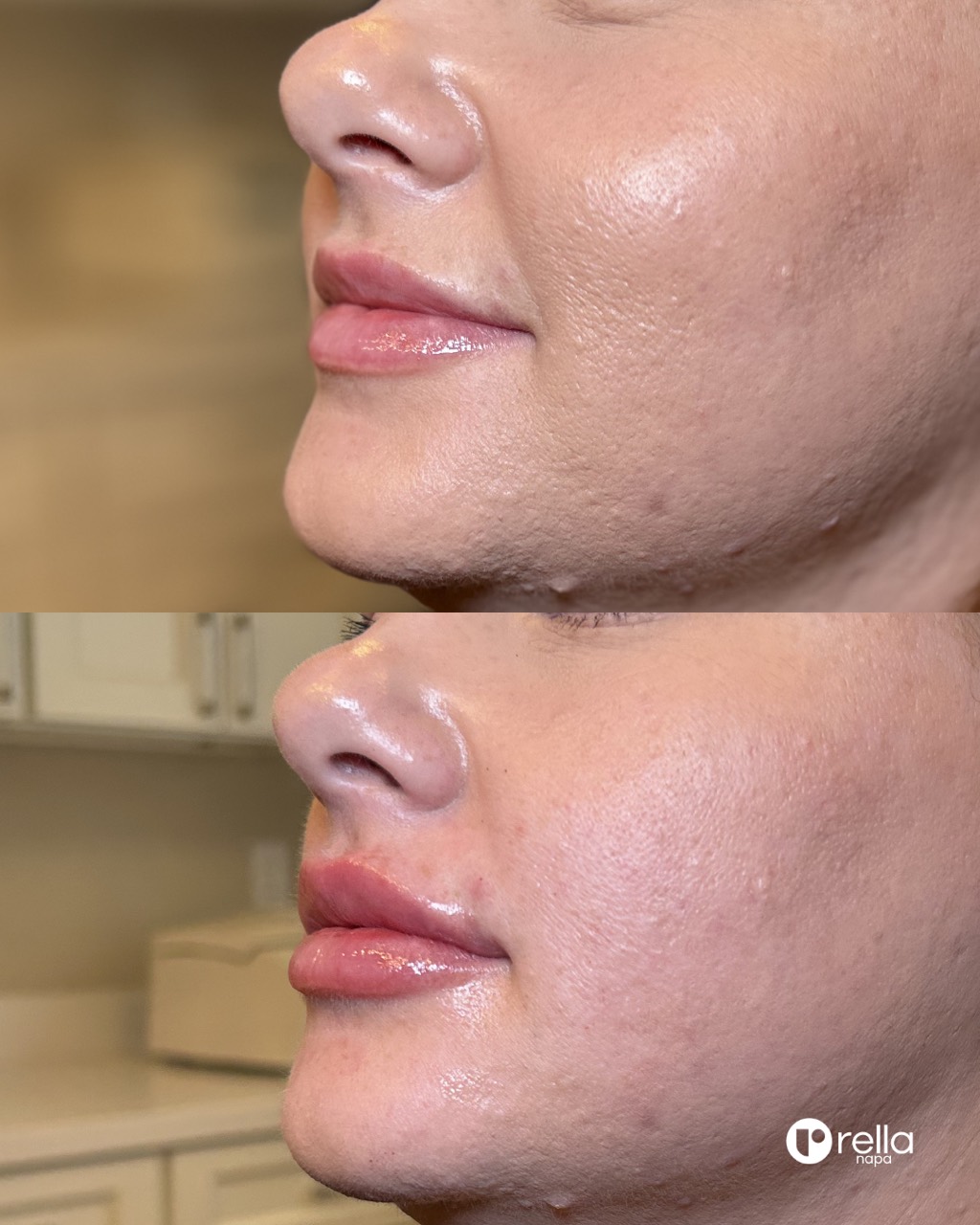 Before-and-after lip result shared with Rella Aesthetics