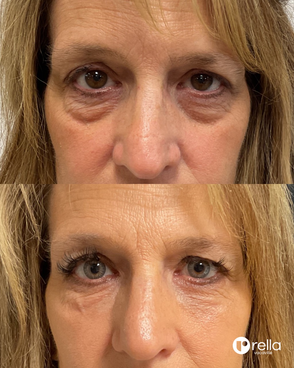 Before-and-after under-eye filler result shared with Rella Aesthetics
